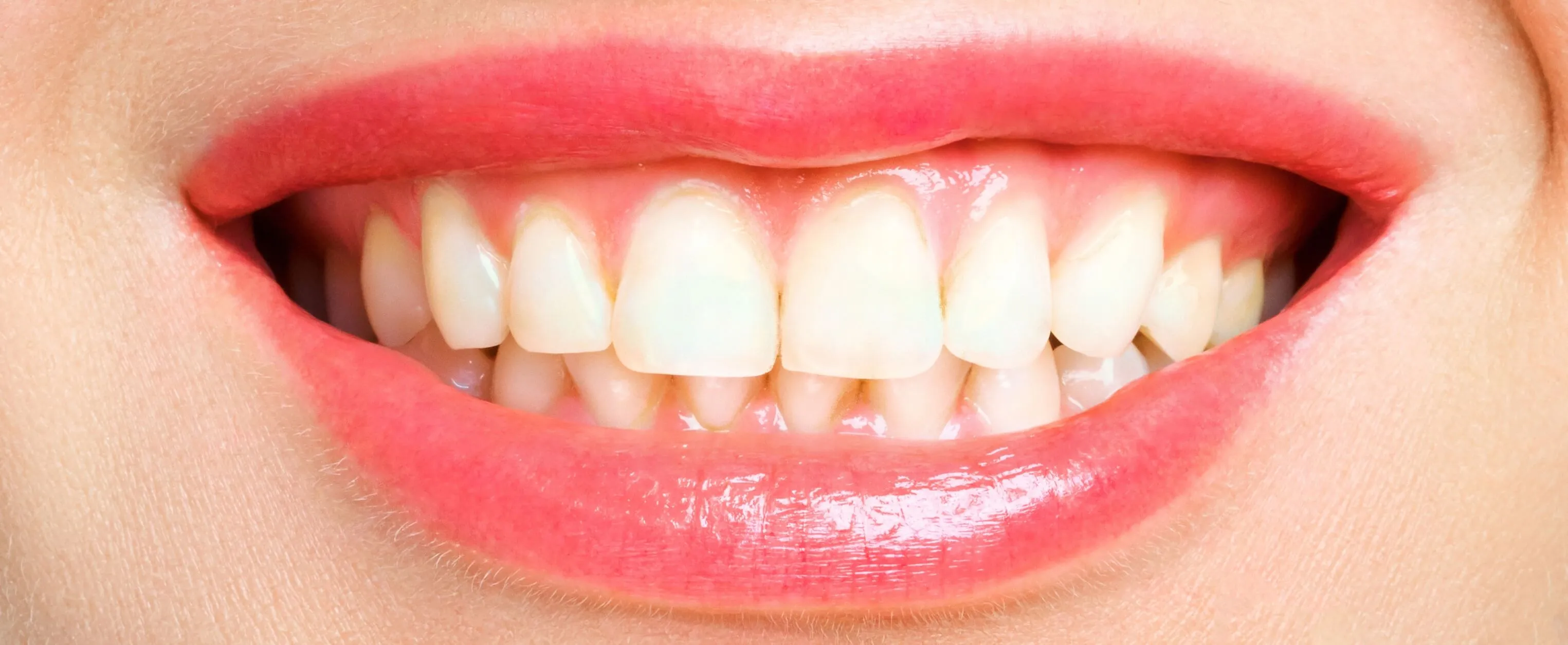 Sorriso mostrando todos os dentes, antes do clareamento