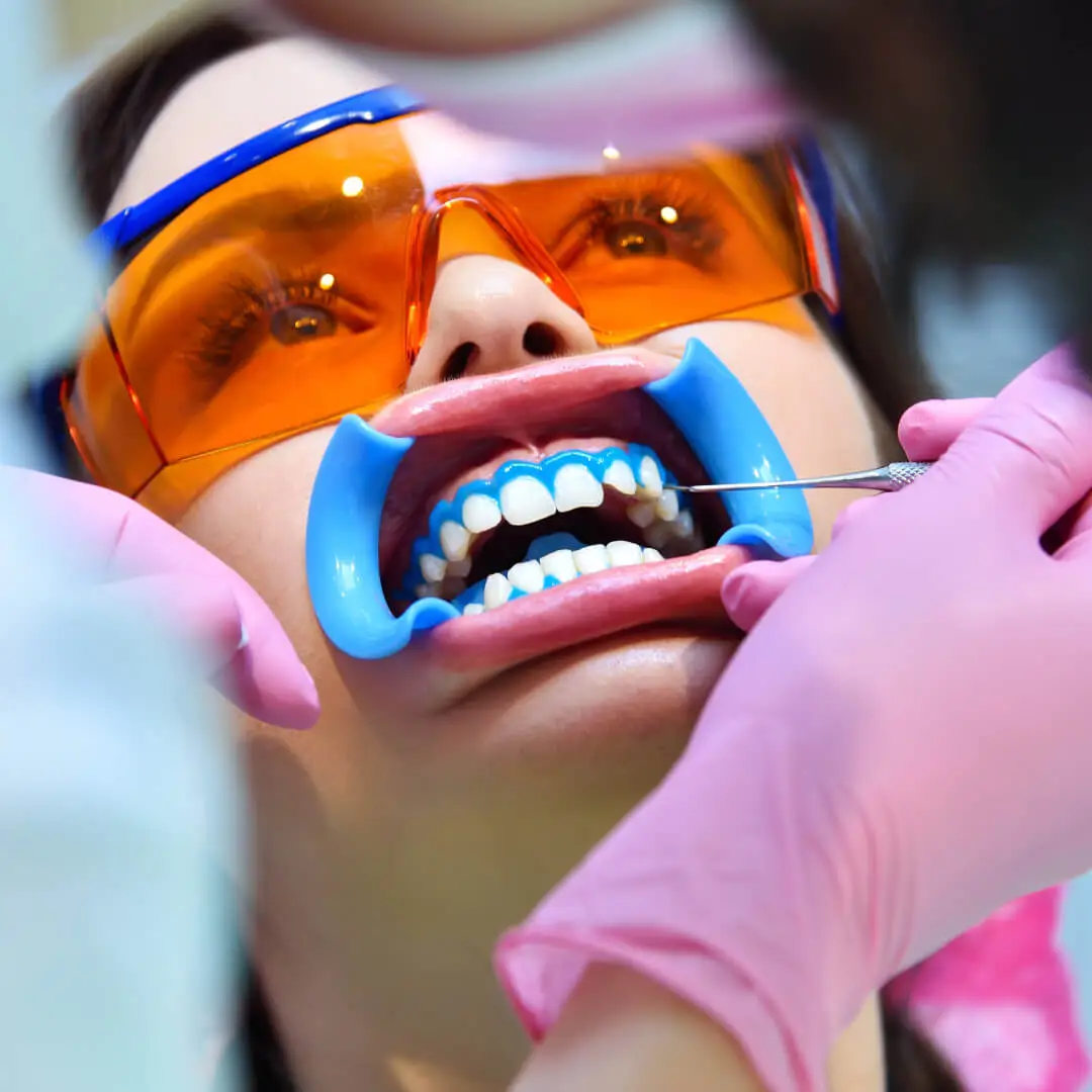 Paciente em procedimento clínico de clareamento dental no consultório