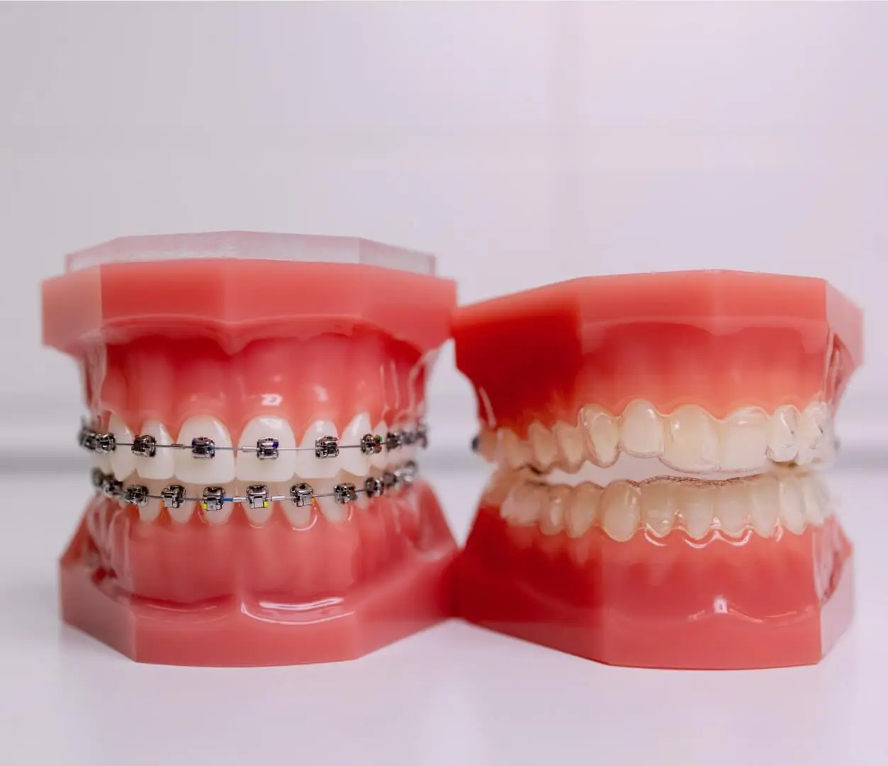 Duas próteses, a primeira com aparelho fixo e a segunda com alinhador invisível (invisalign)